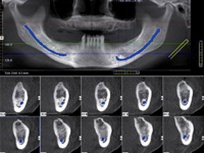 DVT zur Implantatplanung