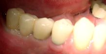 mit Implantaten versorgte Freiendsituation mit Implantaten versorgte Freiendsituation
